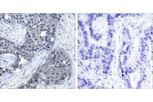 P-Peptide - +Immunohistochemical analysis of paraffin-embedded human breast carcinoma tissue using elF4E (phospho- Ser209) antibody. (EIF4E antibody  (pSer209))