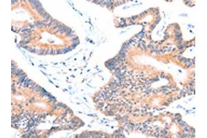 The image on the left is immunohistochemistry of paraffin-embedded Human colon cancer tissue using ABIN7128444(AOC1 Antibody) at dilution 1/15, on the right is treated with fusion protein. (DAO antibody)