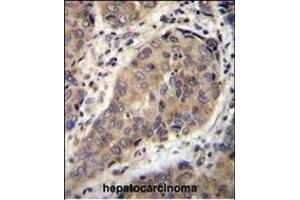 WTIP Antibody (C-term) (ABIN655782 and ABIN2845217) immunohistochemistry analysis in formalin fixed and paraffin embedded human hepatocarcinoma followed by peroxidase conjugation of the secondary antibody and DAB staining. (WTIP antibody  (AA 243-271))