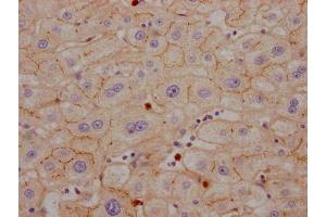 IHC image of ABIN7127422 diluted at 1:100 and staining in paraffin-embedded human liver cancer performed on a Leica BondTM system.