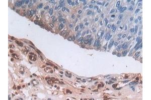 Detection of DEFa3 in Human Prostate cancer Tissue using Polyclonal Antibody to Defensin Alpha 3, Neutrophil Specific (DEFa3) (DEFa3 antibody  (AA 21-94))