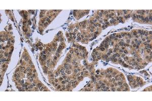 Immunohistochemistry of paraffin-embedded Human breast cancer tissue using IPO8 Polyclonal Antibody at dilution 1:50 (Importin 8 antibody)