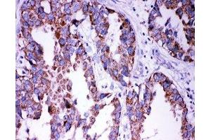 IHC-P: DISC1 antibody testing of human lung cancer tissue