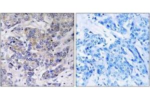 Immunohistochemistry analysis of paraffin-embedded human breast carcinoma tissue, using RPS21 Antibody.