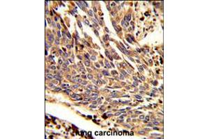 Formalin-fixed and paraffin-embedded human lung carcinoma reacted with ARPC1B Antibody , which was peroxidase-conjugated to the secondary antibody, followed by DAB staining. (ARPC1B antibody  (AA 159-188))