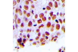 Immunohistochemical analysis of MSH2 staining in human breast cancer formalin fixed paraffin embedded tissue section. (MSH2 antibody)