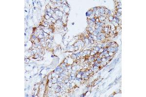 Immunohistochemistry of paraffin-embedded human colon carcinoma using MANBA antibody (ABIN7268392) at dilution of 1:100 (40x lens). (MANBA antibody  (AA 18-300))