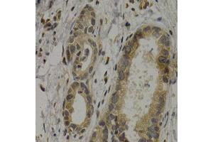 Immunohistochemistry of paraffin-embedded human stomach cancer using MAGEA1 antibody at dilution of 1:200 (400x lens). (MAGEA1 antibody)