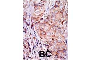 Formalin-fixed and paraffin-embedded human cancer tissue reacted with the primary antibody, which was peroxidase-conjugated to the secondary antibody, followed by AEC staining. (TRIB3 antibody  (N-Term))