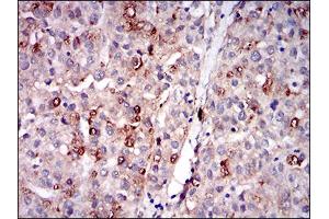 Immunohistochemical analysis of paraffin-embedded liver cancer tissues using PLIN2 mouse mAb with DAB staining. (ADRP antibody  (AA 286-437))