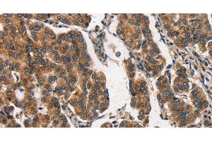 Immunohistochemistry of paraffin-embedded Human breast cancer using ITGA2 Polyclonal Antibody at dilution of 1:30 (ITGA2 antibody)