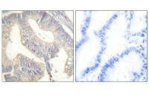 Immunohistochemical analysis of paraffin-embedded human colon carcinoma tissue using Gastrin antibody. (Gastrin antibody)