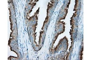 Immunohistochemical staining of paraffin-embedded Carcinoma of liver tissue using anti-PRKAR2A mouse monoclonal antibody.