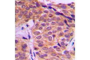 Immunohistochemical analysis of YAP1 staining in human breast cancer formalin fixed paraffin embedded tissue section. (YAP1 antibody  (Center))