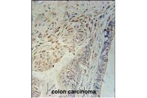CCD92 Antibody (Center) (ABIN651208 and ABIN2840130) immunohistochemistry analysis in formalin fixed and paraffin embedded human colon carcinoma followed by peroxidase conjugation of the secondary antibody and DAB staining. (CCDC92 antibody  (AA 177-205))
