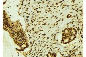 ABIN6274464 at 1/100 staining Human breast cancer tissue by IHC-P.