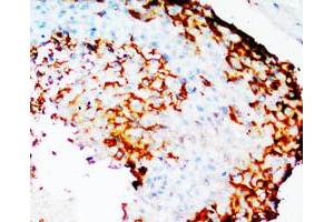 Immunohistochemical staining of PTGS2 on formalin fixed, paraffin embedded human mammary cancer with PTGS2 polyclonal antibody . (PTGS2 antibody  (N-Term))