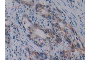 Detection of PKBb in Human Stomach cancer Tissue using Polyclonal Antibody to Protein Kinase B Beta (PKBb) (AKT2 antibody  (AA 142-412))