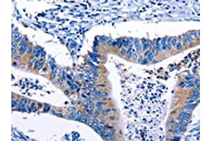 The image on the left is immunohistochemistry of paraffin-embedded Human colon cancer tissue using ABIN7193124(Gjc3 Antibody) at dilution 1/10, on the right is treated with synthetic peptide. (GJC3 antibody)