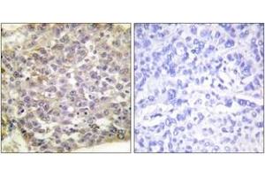 Immunohistochemistry analysis of paraffin-embedded human breast carcinoma tissue, using 14-3-3 zeta (Ab-58) Antibody. (14-3-3 zeta antibody  (AA 24-73))