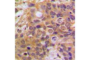 Immunohistochemical analysis of DAXX staining in human breast cancer formalin fixed paraffin embedded tissue section.