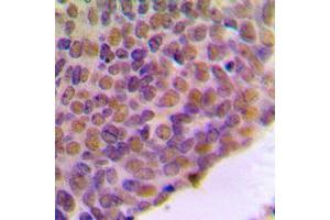 Immunohistochemical analysis of BRCA1 staining in human breast cancer formalin fixed paraffin embedded tissue section. (BRCA1 antibody  (C-Term))