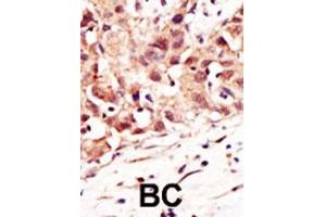 Formalin-fixed and paraffin-embedded human cancer tissue reacted with the primary antibody, which was peroxidase-conjugated to the secondary antibody, followed by DAB staining. (SENP5 antibody  (C-Term))