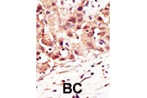 Formalin-fixed and paraffin-embedded human cancer tissue reacted with the primary antibody, which was peroxidase-conjugated to the secondary antibody, followed by DAB staining. (SENP5 antibody  (C-Term))