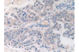 IHC-P analysis of Human Breast Cancer Tissue, with DAB staining. (FDFT1 antibody  (AA 269-417))