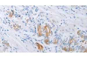 Immunohistochemistry of paraffin-embedded Human gastric cancer using LOX Polyclonal Antibody at dilution of 1:30 (LOX antibody)