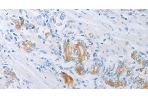 Immunohistochemistry of paraffin-embedded Human gastric cancer using LOX Polyclonal Antibody at dilution of 1:30 (LOX antibody)
