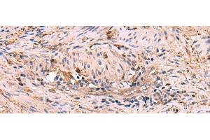 Immunohistochemistry of paraffin-embedded Human cervical cancer tissue using MAPK8IP3 Polyclonal Antibody at dilution of 1:45(x200) (JIP3 antibody)