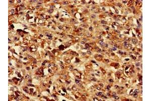 Immunohistochemistry of paraffin-embedded human melanoma using ABIN7173215 at dilution of 1:100 (TMEM43 antibody  (AA 178-312))