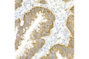 Immunohistochemistry of paraffin-embedded human colon carcinoma using SLC12 Rabbit pAb (ABIN6131136, ABIN6147843, ABIN6147844 and ABIN6215366) at dilution of 1:50 (40x lens). (SLC12A2 antibody  (AA 120-280))