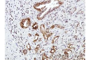 IHC-P Image Immunohistochemical analysis of paraffin-embedded Human pancreatic tumor, using CXCR7, antibody at 1:100 dilution. (CXCR7 antibody)