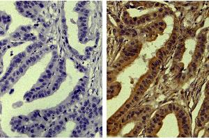 Paraffin embedded human gastric cancer tissue was stained with Mouse Anti-Human TIMP-4-UNLB (SB. (TIMP4 antibody  (HRP))