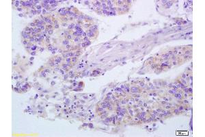 Formalin-fixed and paraffin embedded human lung carcinoma labeled with Anti-D-1/CD279 Polyclonal Antibody, Unconjugated (ABIN735608) at 1:200 followed by conjugation to the secondary antibody and DAB staining. (PD-1 antibody  (AA 201-288))