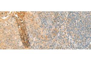 Immunohistochemistry of paraffin-embedded Human tonsil tissue using GPT2 Polyclonal Antibody at dilution of 1:70(x200)