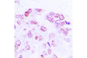 Immunohistochemical analysis of ATF2 staining in human lung cancer formalin fixed paraffin embedded tissue section. (ATF2 antibody  (Center))