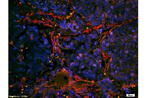Formalin-fixed and paraffin embedded human lung carcinoma labeled with Anti- Integrin alpha 7/ITGA7 Polyclonal Antibody, Unconjugated (ABIN734858) at 1:200 followed by conjugation to the secondary antibody Goat Anti-Rabbit IgG, Cy3 conjugated used at 1:200 dilution for 40 minutes at 37°C (ITGA7 antibody  (AA 701-800))
