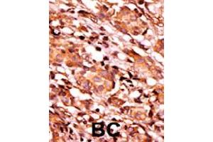 Formalin-fixed and paraffin-embedded human cancer tissue reacted with BAD (phospho S134) polyclonal antibody  which was peroxidase-conjugated to the secondary antibody followed by AEC staining.
