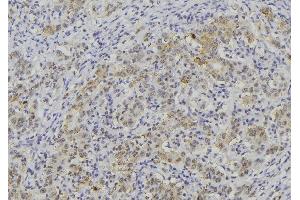 ABIN6276383 at 1/100 staining Human lung cancer tissue by IHC-P. (WNT3A antibody  (Internal Region))