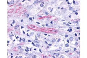 Anti-GPR124 / TEM5 antibody IHC of human Prostate, Carcinoma Endothelial Cells. (GPR124 antibody  (N-Term))