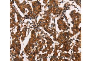 Immunohistochemistry of Human thyroid cancer using ATRN Polyclonal Antibody at dilution of 1:50 (Attractin antibody)