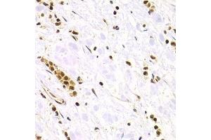 Immunohistochemistry of paraffin-embedded human gastric cancer using RAD50 Antibody. (RAD50 antibody)
