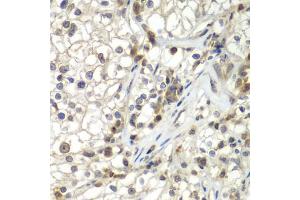 Immunohistochemistry of paraffin-embedded human kidney cancer using ASPSCR1 antibody (ABIN5975297) at dilution of 1/100 (40x lens). (ASPSCR1 antibody)
