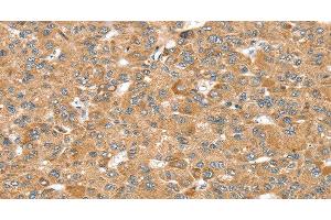 Immunohistochemistry of paraffin-embedded Human liver cancer using MORF4L1 Polyclonal Antibody at dilution of 1:35 (MORF4L1 antibody)