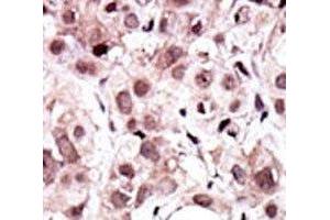 IHC analysis of FFPE human cancer tissue stained with the AXL antibody (AXL antibody  (AA 13-44))