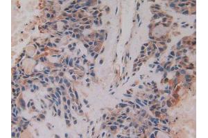 IHC-P analysis of Human Lung Cancer Tissue, with DAB staining. (CKMT1A antibody  (AA 41-250))