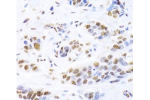 Immunohistochemistry of paraffin-embedded Human breast cancer using XRCC5 Polyclonal Antibody at dilution of 1:100 (40x lens). (XRCC5 antibody)